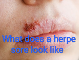 What does a herpe sore look like