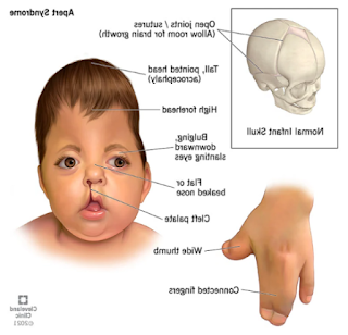 Apert Syndrome treatments, diagnosis and symptoms in children and adolescents