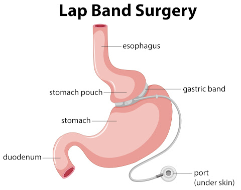 lap band surgery in Melbourne