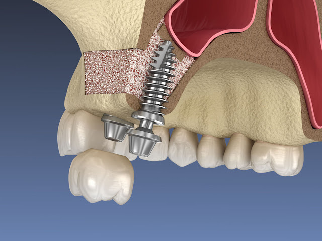 sinus lift