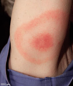 infant heat rash pictures. infant heat rash pictures. infant heat rash pictures.