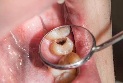 Triệu chứng đau răng sâu bạn nên biết