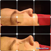 Micromotor Assisted Natural Rhinoplasty,Natural nose job for women, Simple rhinoplasty, Personal nose cosmetic procedure