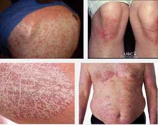 Gejala Penyakit Eksim Atau Dermatitis