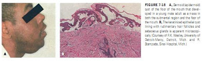 CYSTS OF THE JAWS AND BENIGN ODONTOGENIC TUMORS Cysts of the Jaw