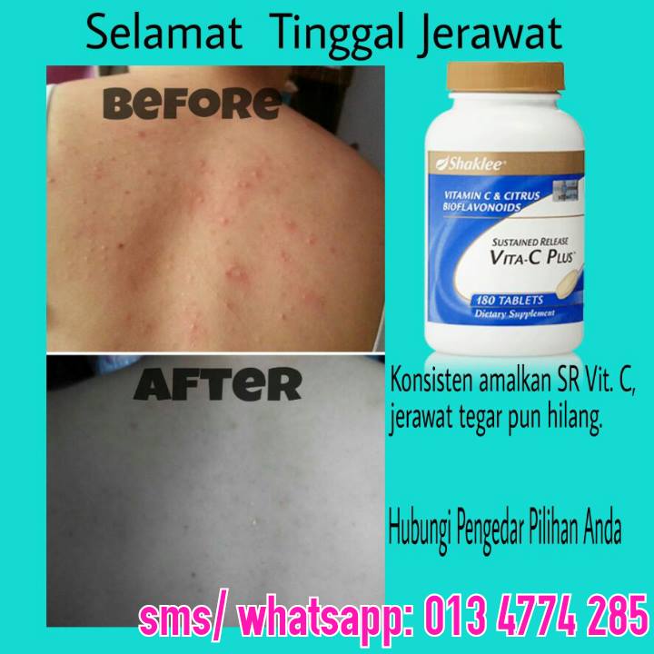 Cara Menghilangkan Jerawat Belakang Badan Tanpa Rawatan 