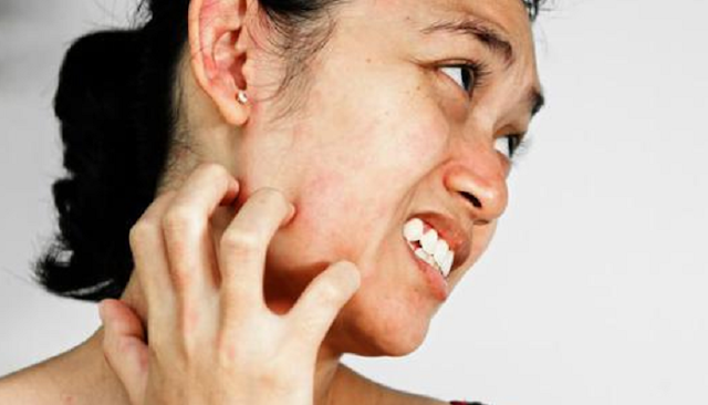 7 itchy acne Effects and Its Causes