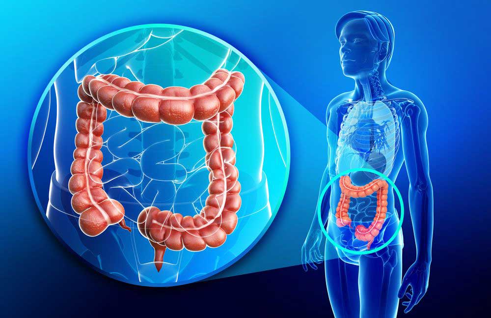 Cancer Colorectal