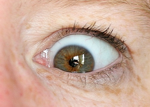 oh my eye again