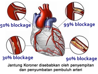 Epidemiologi Penyakit Tidak Menular FKM UNSRI Penyakit 