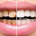 Dental Veneers: Procedure, Benefits and Cost