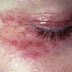 Pengobatan Herpes Pada Mata