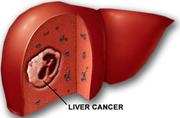 defini penyakit liver
