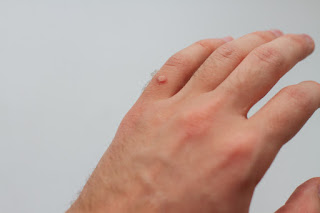 wart removal