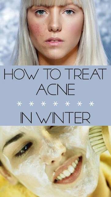 4 Tips to Keep Acne Skin Healthy This Winter