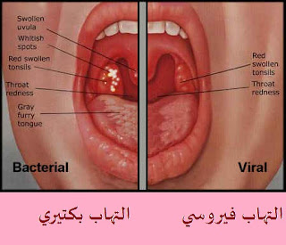 التهاب الحلق