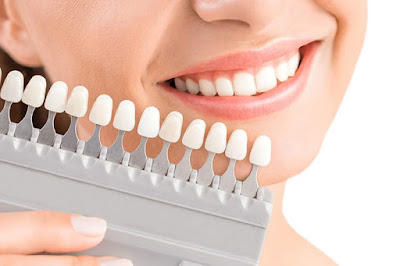 Có nên làm răng sứ không khi bị gãy răng? 2