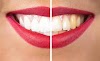 9 Steps to Whiten Your Teeth at Home: A Leading and Nimble Plan for a Brighter Smile