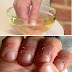 Home Remedy For Hangnails