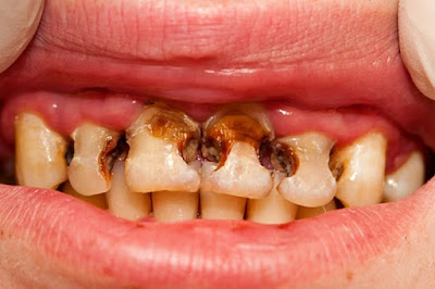 Nguyên nhân gây sâu răng hàm trên 