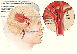 Cara Mencegah Penyakit Stroke 