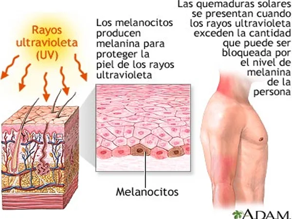 Efectos de los rayos uv en el Vitíligo