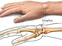 CARA MENYEMBUHKAN GANGLION CYST DENGAN QUANTUM HEALING