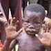 Monkeypox is transmitted to humans from rodents, pets, and primates