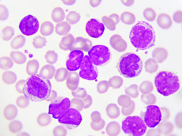 Chronic Myeloid Leukemia Treatment