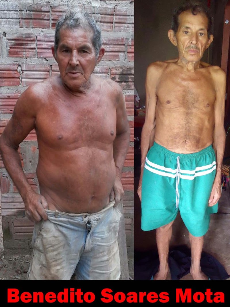 Esperantinópolis URGENTE: Idoso pede ajuda para cirurgia (Gastrostomia)