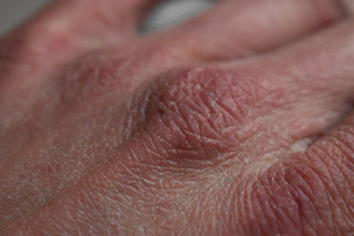 Picture of a human hand with dry skin