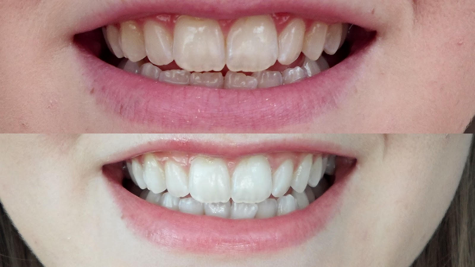 The gallery for --&gt; Teeth Whitening Strips Reviews