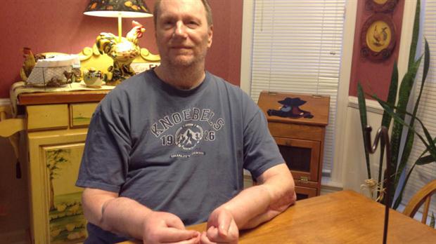 Hombre dice arrepentirse de haber recibido trasplante de manos