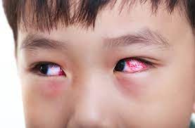 Eye Flu Symptoms in Children