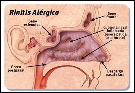 mi congestion nasal