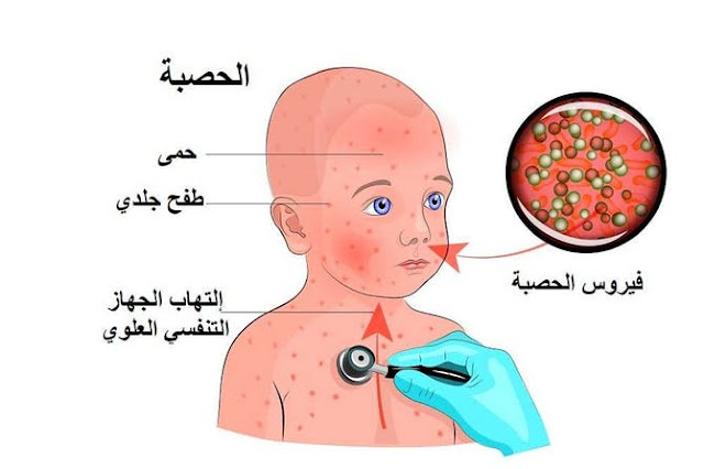 الـحـصـبـة  Measles