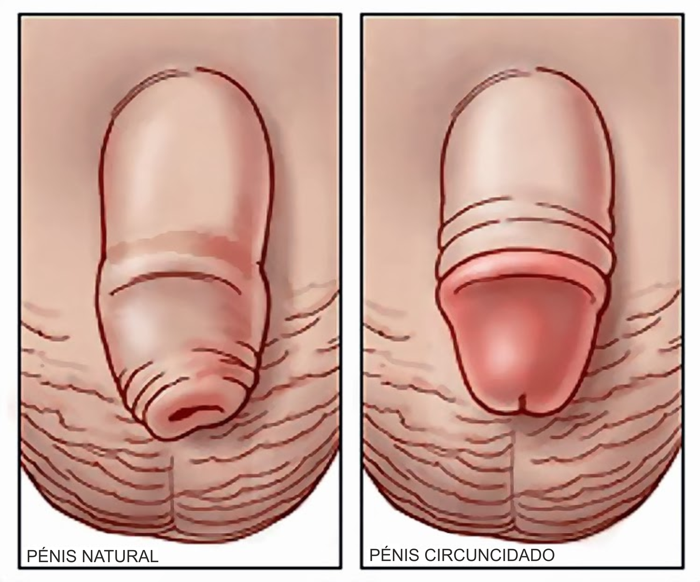 Estudo canadesne mostra os efeitos da circuncisão