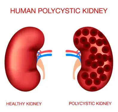 Autosomal Recessive Polycystic Kidney Disease (ARPKD): A Comprehensive Guide