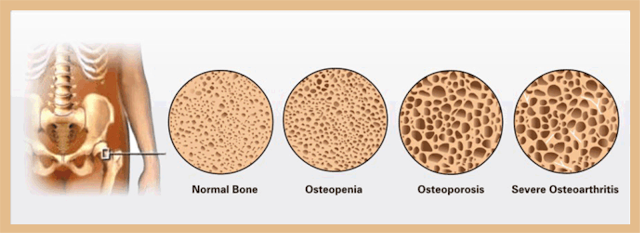 Pemeriksaan Tulang dan Penyakit Osteoporosis