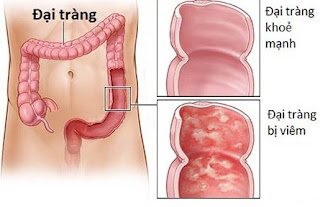 Nguyên nhân triệu chứng của ung thư đại trực tràng