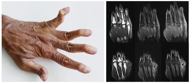 Jaccoud’s arthritis