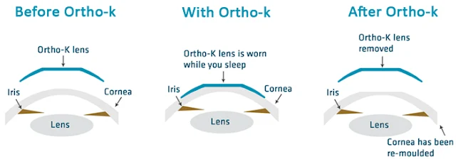 Orthokeratology