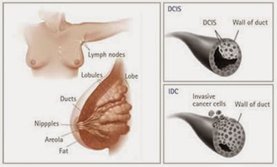 penyembuhan kanker payudara tanpa operasi