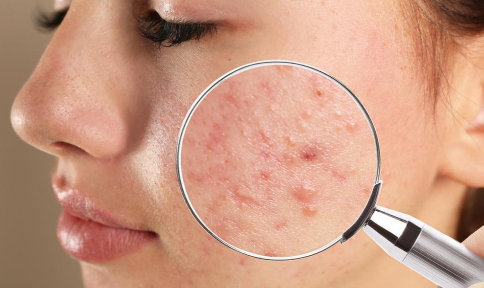 Bacterial Acne: Causes, Treatment, and Tips
