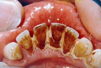  Nguyên nhân răng bị đen bên trong