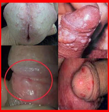 obat sipilis, apakah sipilis bisa sembuh