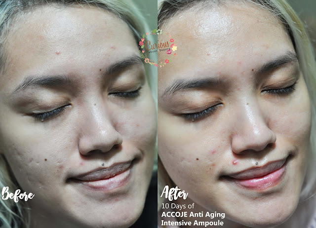 Before After Accoje Anti Aging Intensive Ampoule