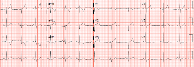 Quiz post - which of these, if any, are OMI? What is the South African Flag Sign? Will you activate the cath lab? Can you tell the difference on ECG?