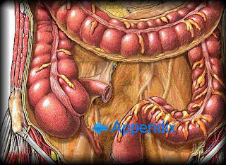 Nursing Diagnosis Askep Appendicitis