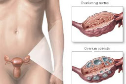 Sindroma Ovarium Polikista
